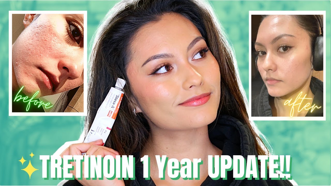 TRETINOIN BEFORE AND AFTER | 1 YEAR EXPERIENCE!!