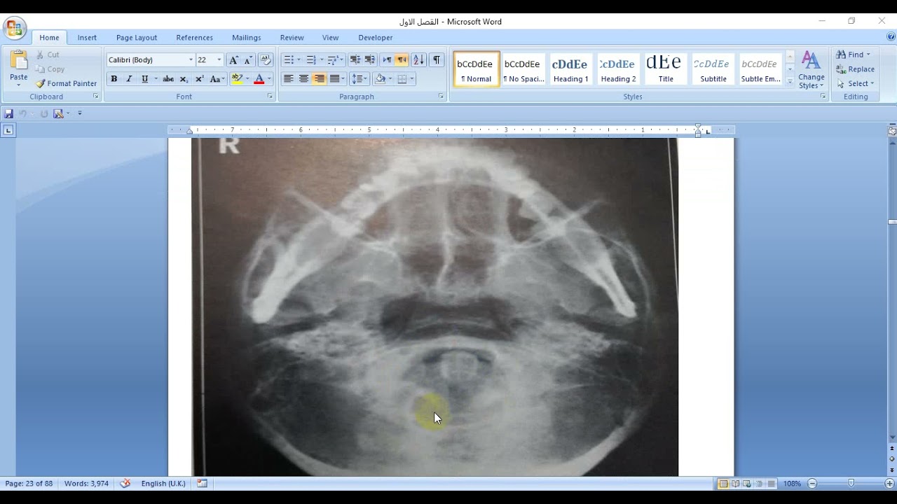 DIAA NAFETH MUTAWA SUBEHAT AP, base of the skull, town's . sellaturcica , PNS..,skull PA, Lateral
