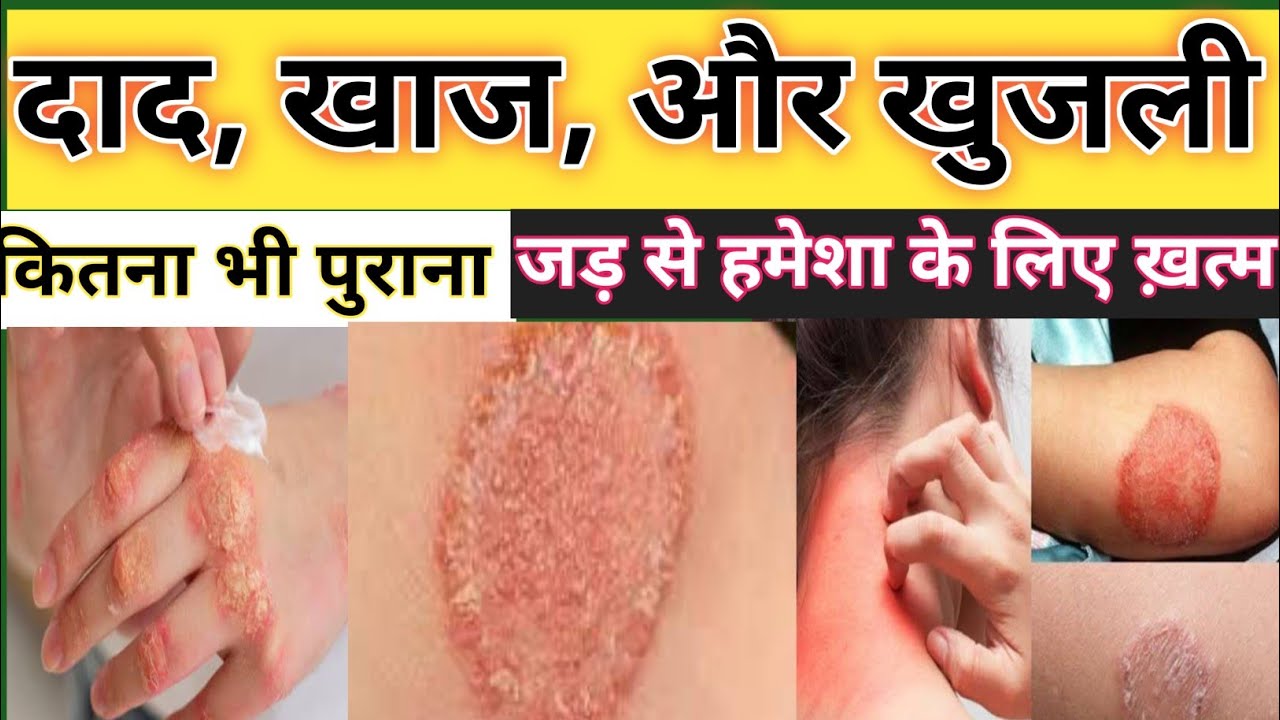  दाद खाज खुजली का परमानेंट इलाज | Fungal Infection Treatment | Itaconazole Luliconazole Full Guide