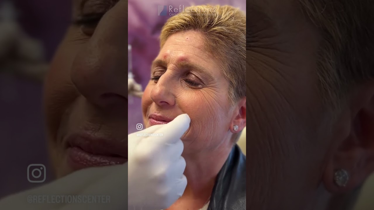 Botox for Radial Lines and Crows Feet