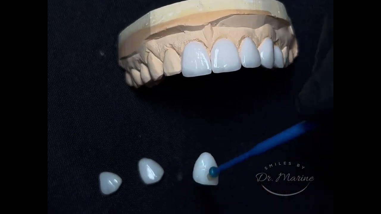 Porcelain Veneers Smile Makeover 