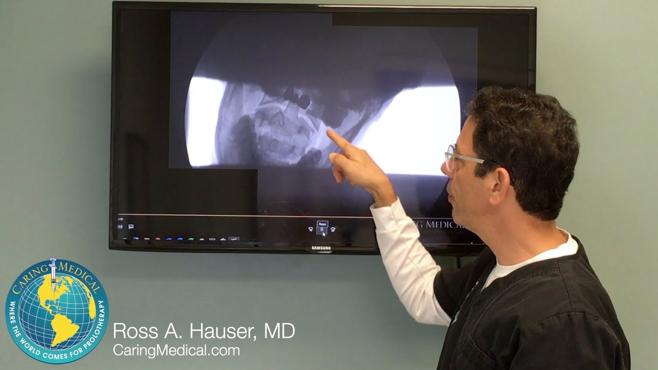 Cause of occipital neuralgia and migraines seen on DMX and resolved with Prolotherapy