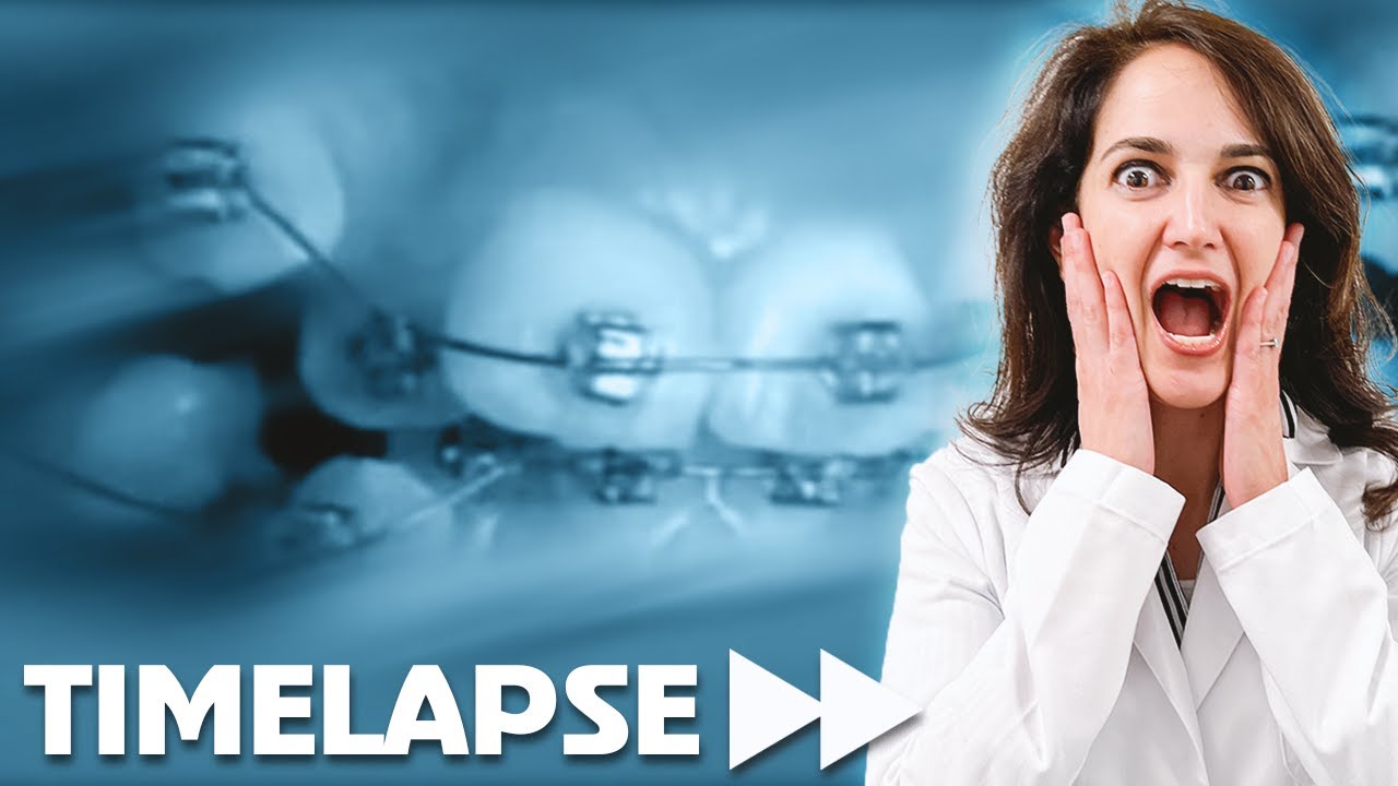 Timelapse of How Braces Change Your Teeth (Dr. Mina Reacts to TikTok video)