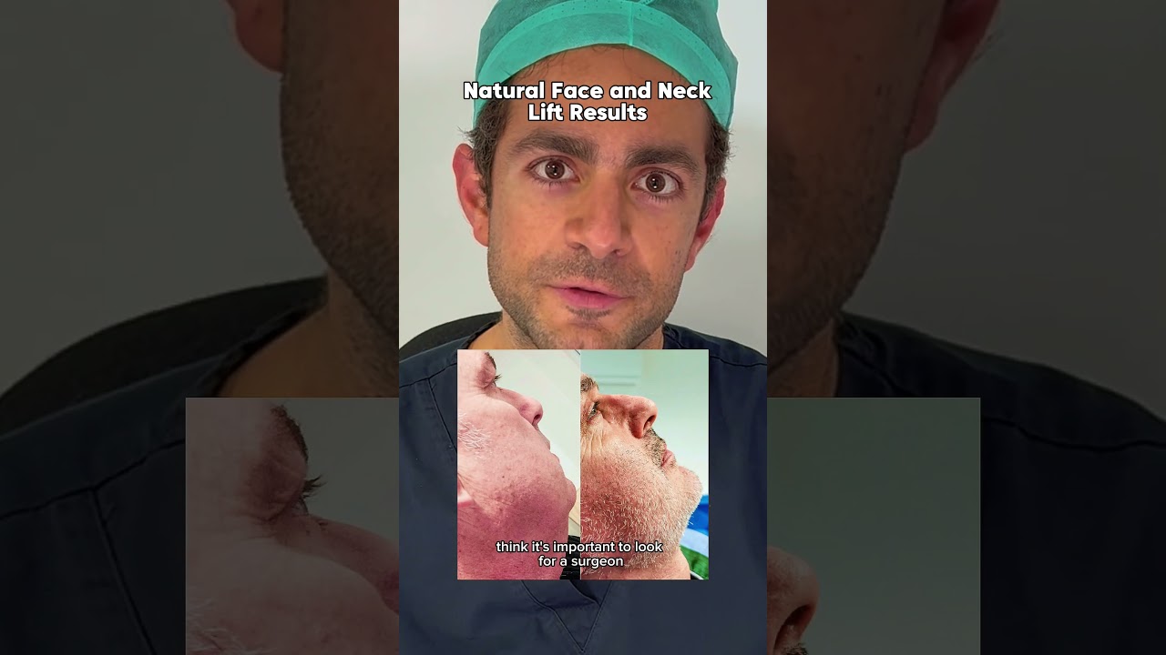 Face lift and neck lift results 😍 #facelift #necklift #facelifttransformation #neckliftresults