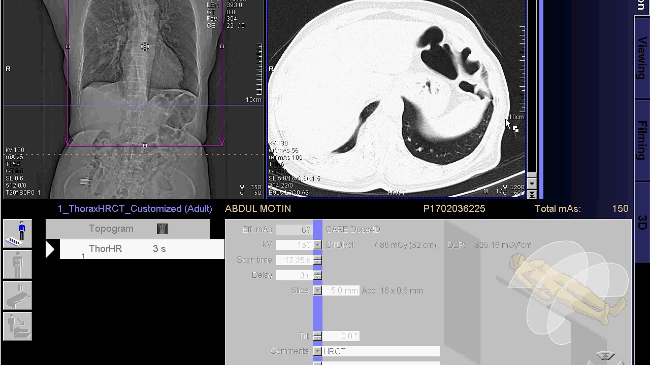 HRCT Scan of  Chest full work 