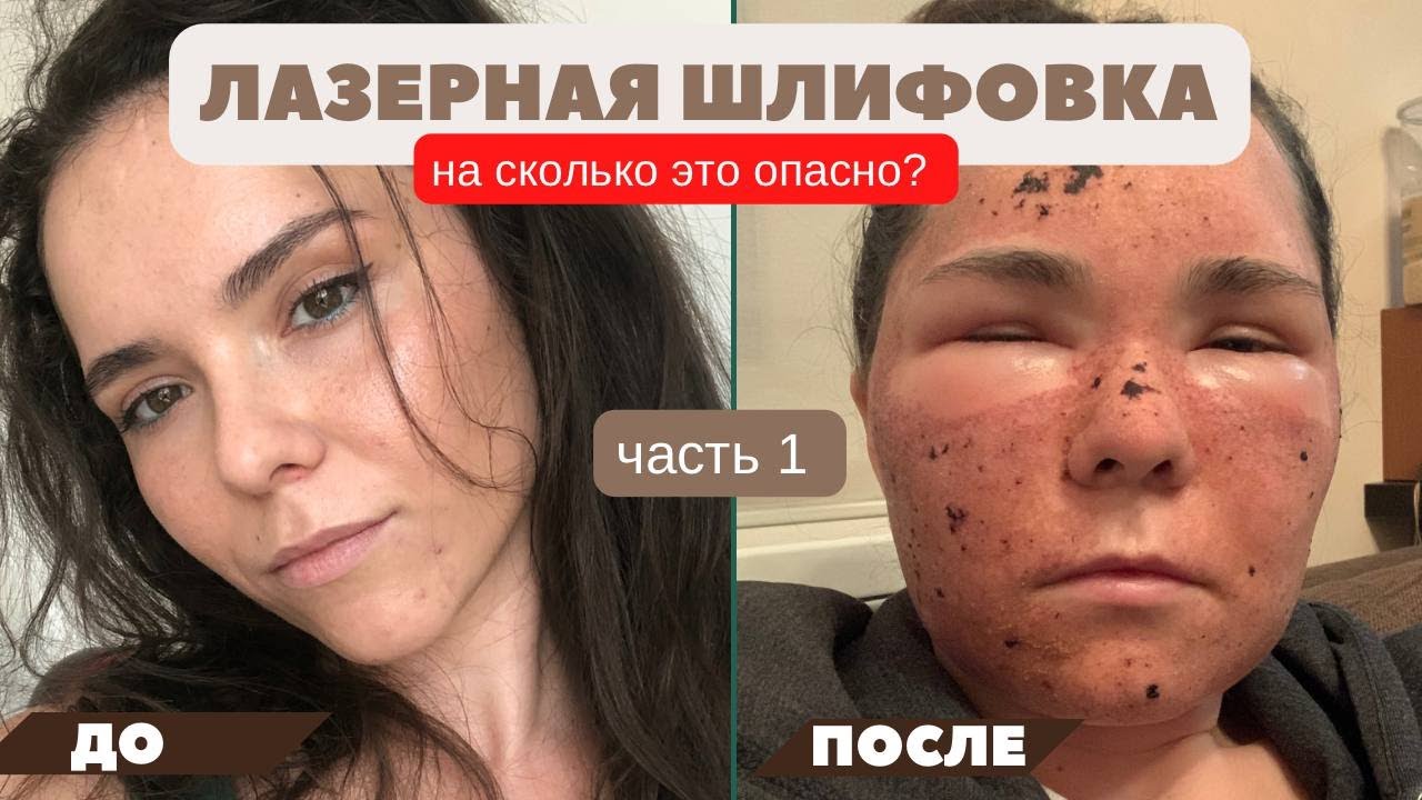 ЛАЗЕРНАЯ ШЛИФОВКА, моя история. Лазерная шлифовка лица CO2 лазером (ЧАСТЬ 1).