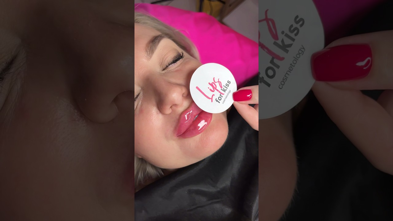 Lips augmentation 🫦 #lifting #fullface #lips #filler #jawline #contouring #beauty #lipfiller
