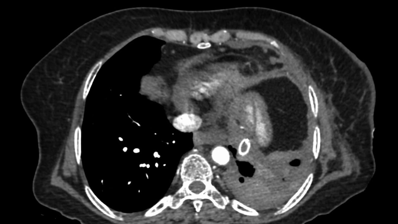TMT: X-RAY CHEST: LEFT OPAQUE HEMITHORAX