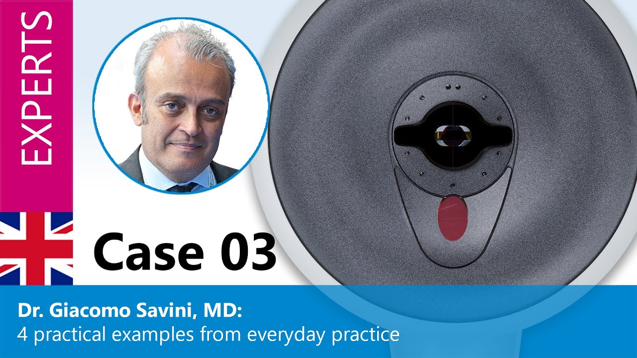 Dr. Giacomo Savini, MD: case 3 of 4 from everyday practice: Trifocal IOL – unhappy patient