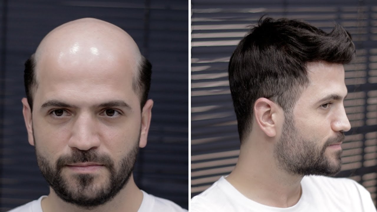 PROTEZ SAÇ İLE DEĞİŞİN! - Hair Replacement