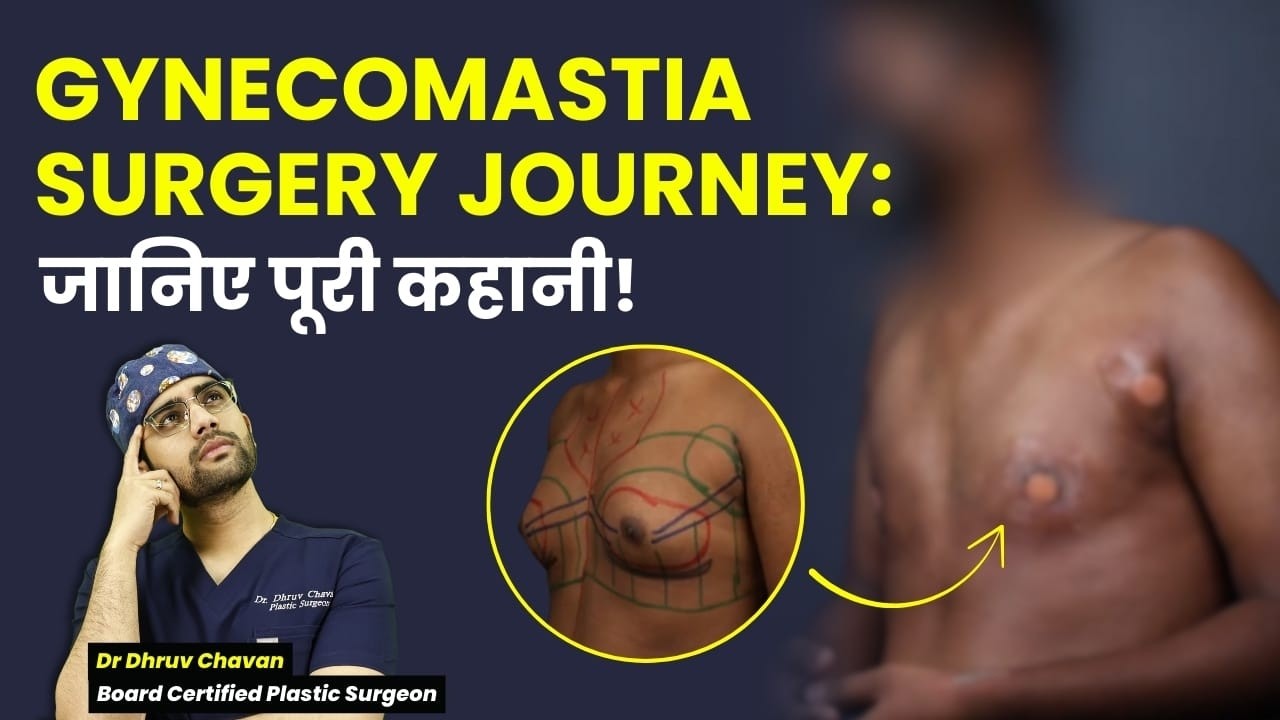 Real Gynecomastia Surgery Experience | पहली Dressing और Recovery! | Dr DC, Plastic Surgeon | Pune