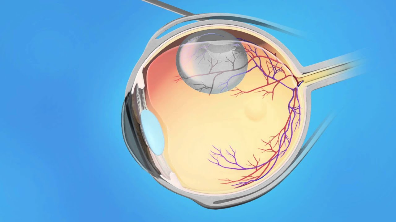 Detached Pneumatic Retinopexy by Retina Consultants of Southern California