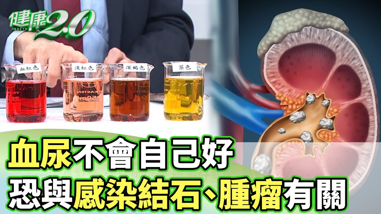 血尿不會自己好 恐與尿路感染.結石.腫瘤有關【健康2.0分段】@tvbshealth20   EP2999-1  20250330 #陳欣湄 #韋汝 #江守山 #黃賢祥 #胡逸惟 #羅珮琳