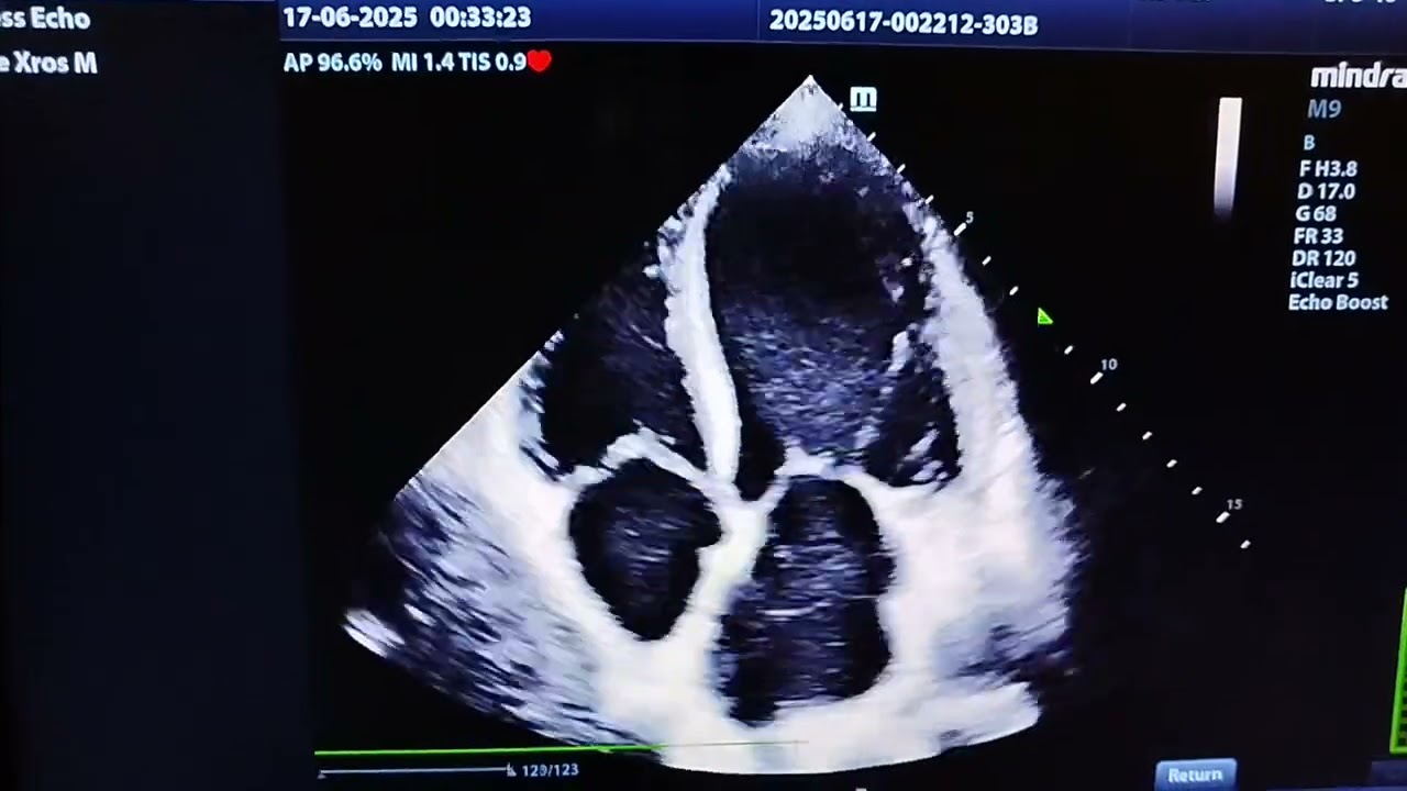Spontaneous Echo contrast & Left atrial thrombus in severely reduced Ejection Fraction Heart EF20 %