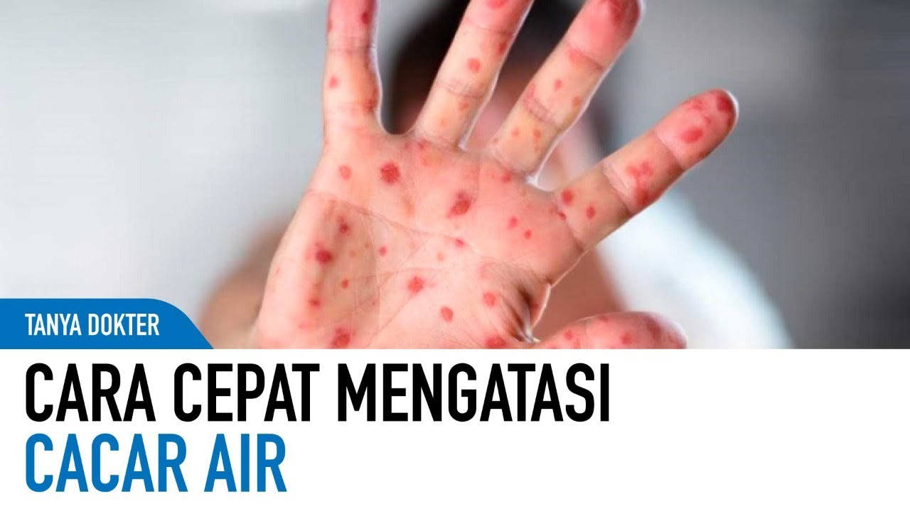 Cepat dan Tidak Membekas! Cara Mengobati Cacar Air Di Rumah | Kata Dokter