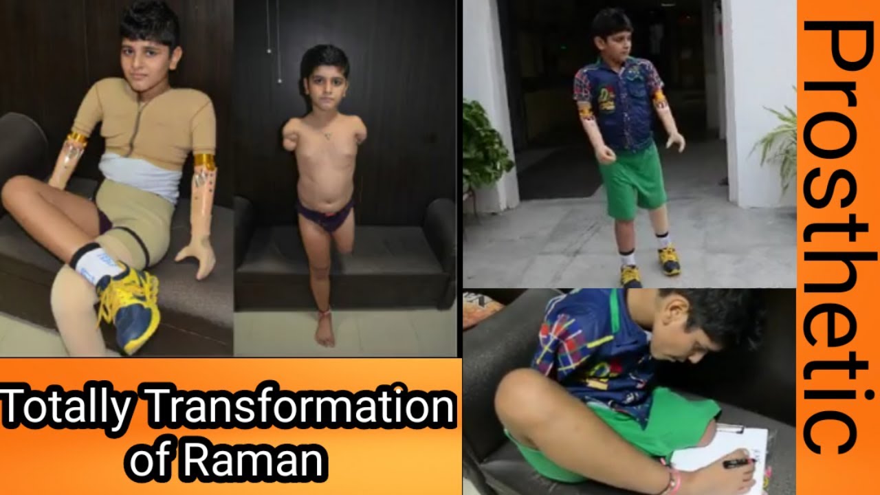 triliteral amputee transformation of child #Artificiallimb @pointernationalprivatelimi3612