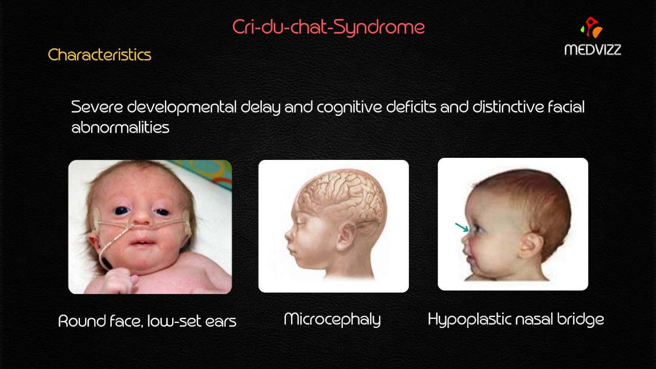 Cri-du-Chat Syndrome - Usmle step 1 lecture