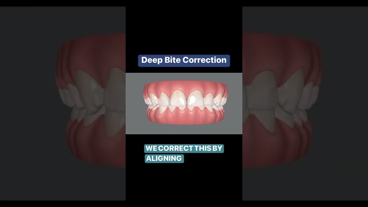 Teeth alignment to correct a deep bite.