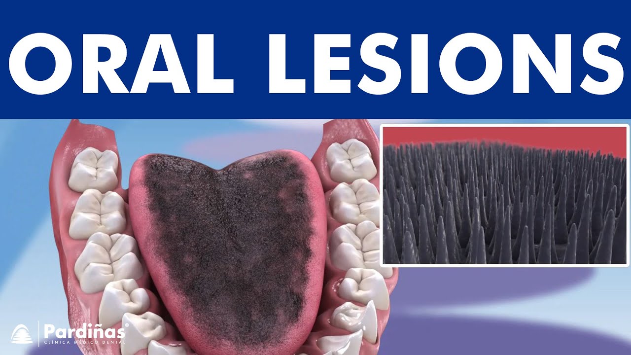 Lichen planus, leukoplakia, geographic tongue, and other oral mucosal lesions &copy;