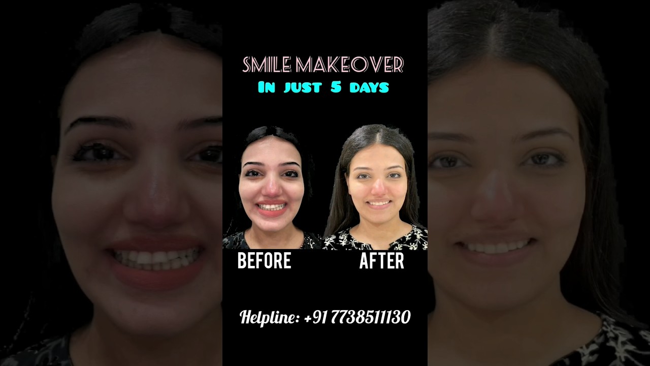 SMILE MAKEOVER IN JUST 5 DAYS 