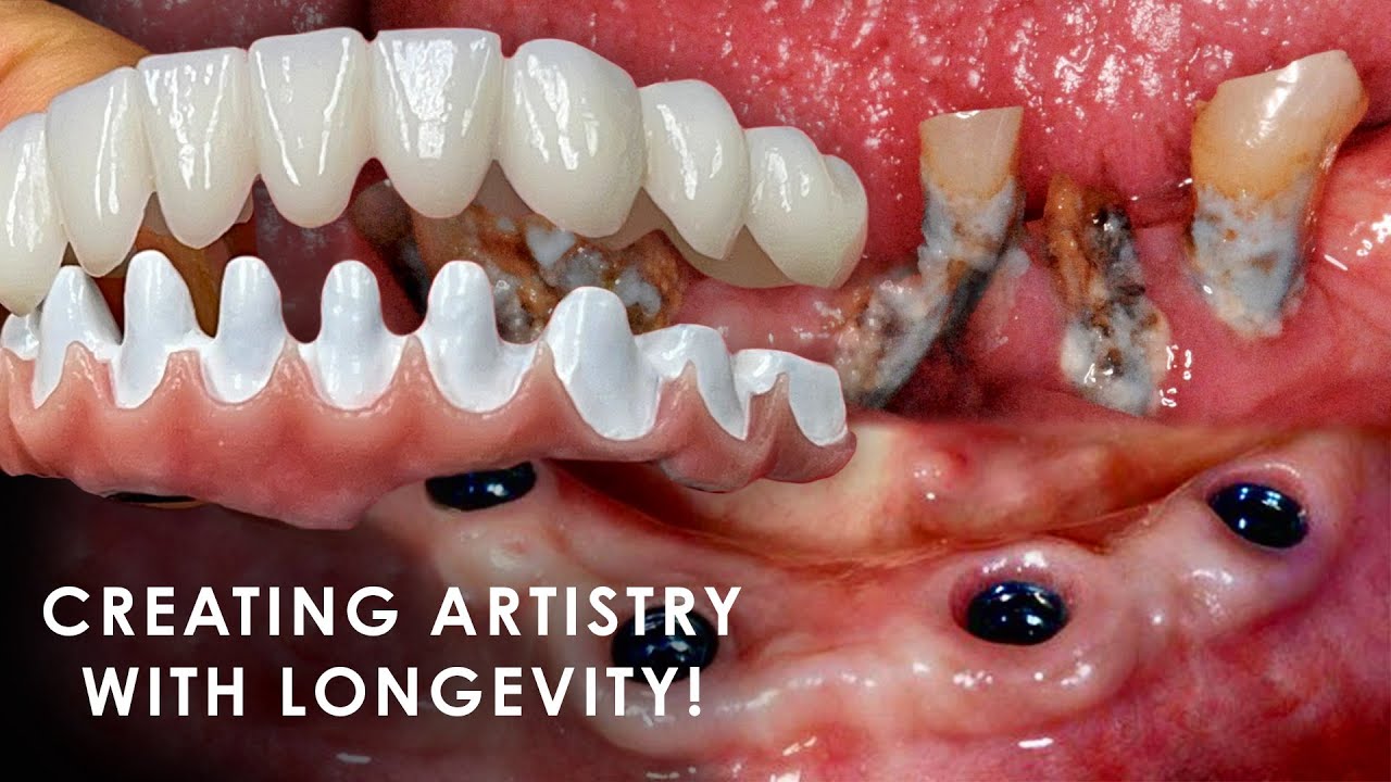 Creating Artistry with Longevity for Full Mouth Implants