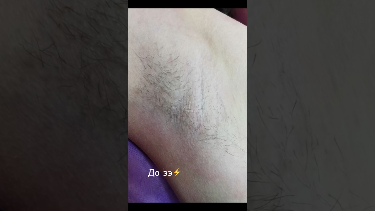 Электроэпиляция до/после 