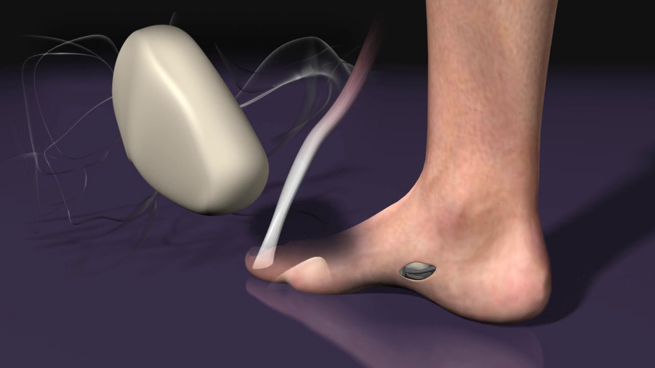 Kidner Procedure with the BIoPro Tendon Anchor System