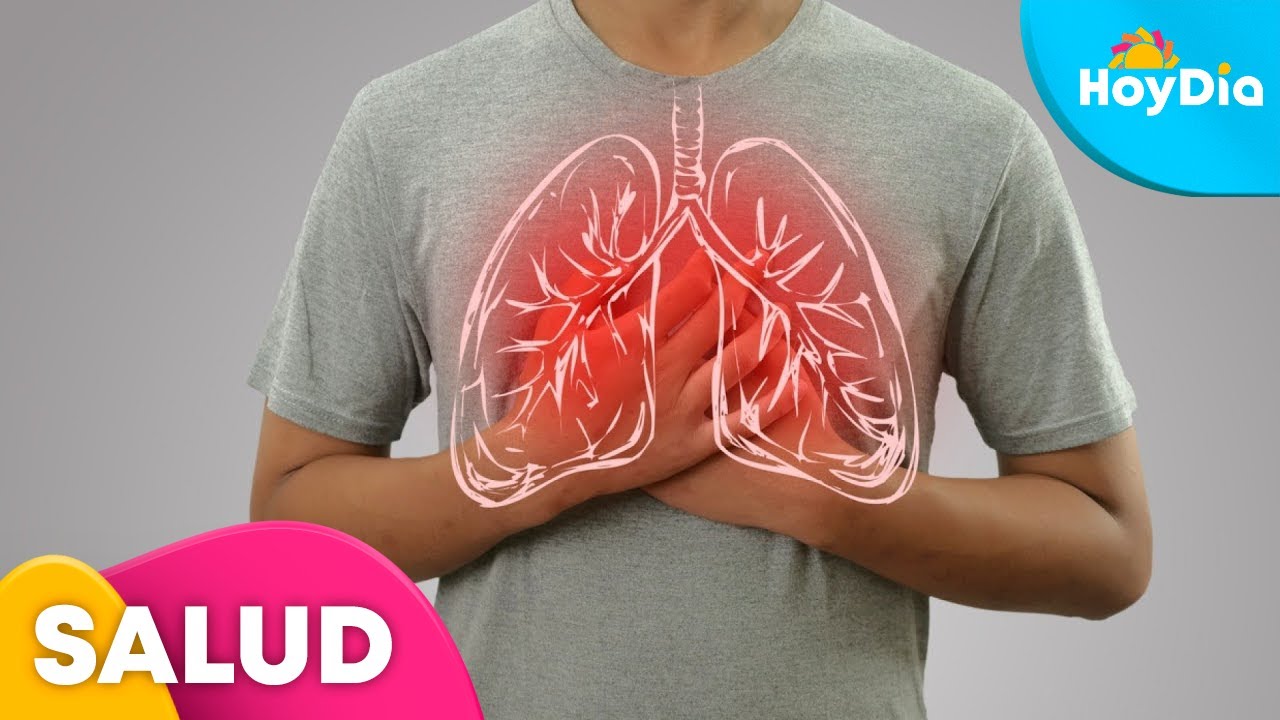 ¿Qué es la pleuresía y cuáles son sus síntomas?, un doctor lo explica | Hoy Día | Telemundo