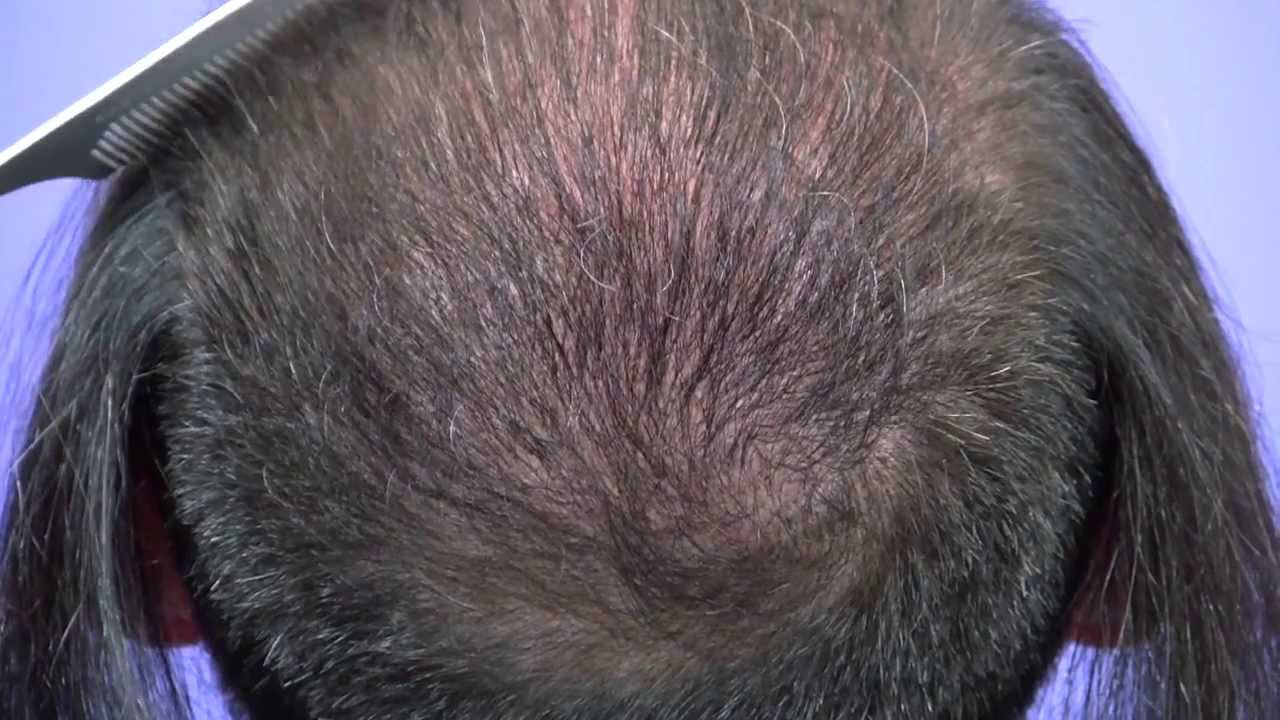 Dr Gabel Patient   2098 follicular unit grafts in to the crown of the scalp