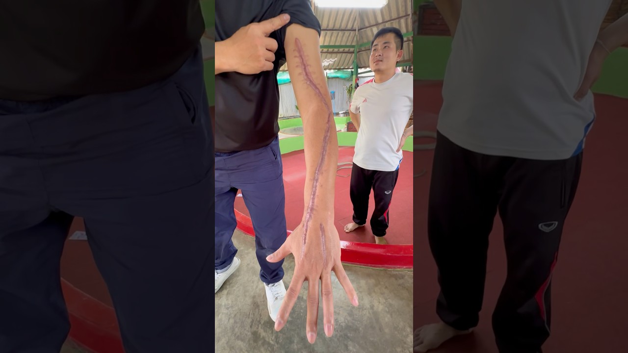 He Survived Multiple Bites from a Cobra! #shorts #kingcobra #snake #bite #phuket #ahas