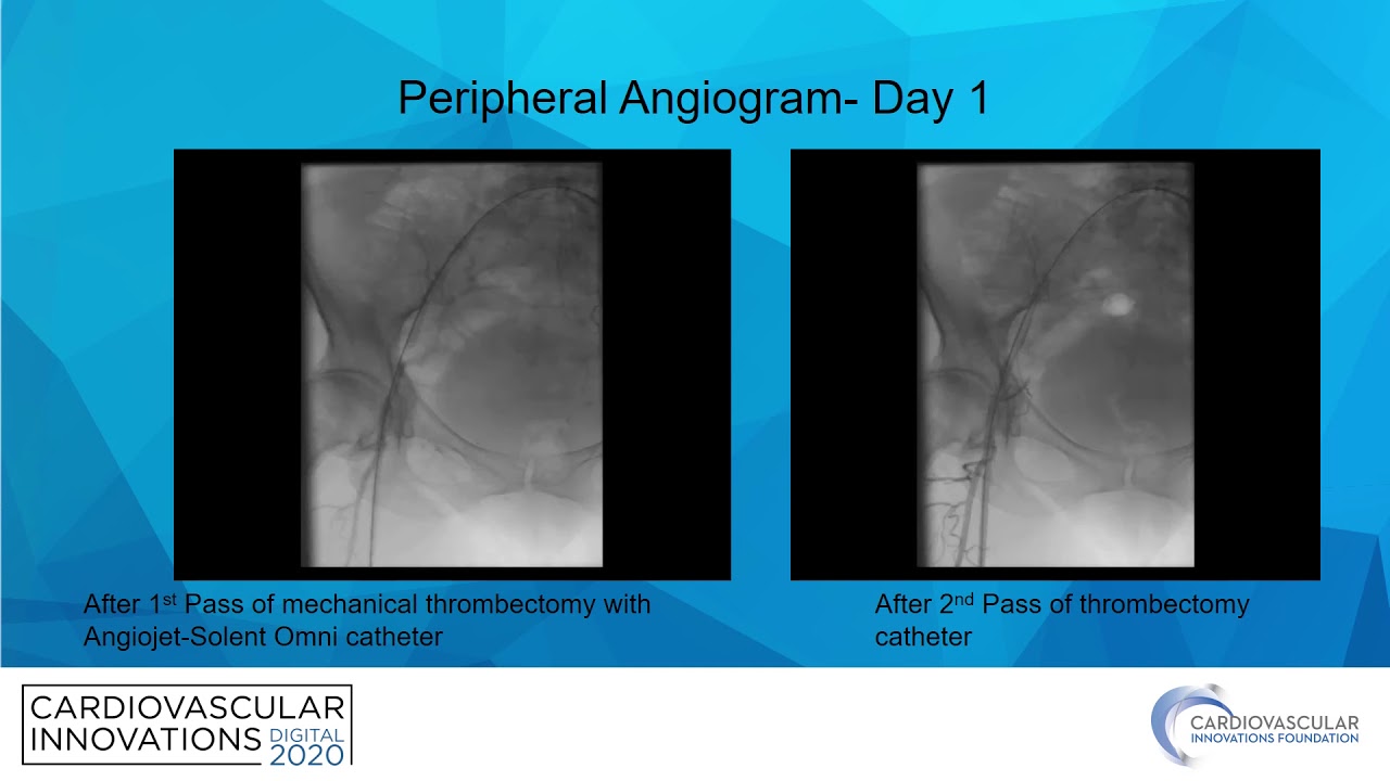 Dahal_Perplexing presentation of Acute Limb Ischemia ALI_Peripheral