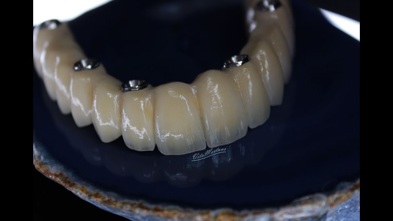 EXOCAD для чайников. балки #smiledesigndental #exocad #implants #crown #dentistry #dentaldesign