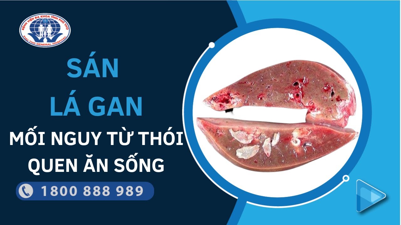 Sán lá gan | Mối nguy hiểm từ việc ăn thức ăn sống | Ths BS Bùi Mạnh Cường