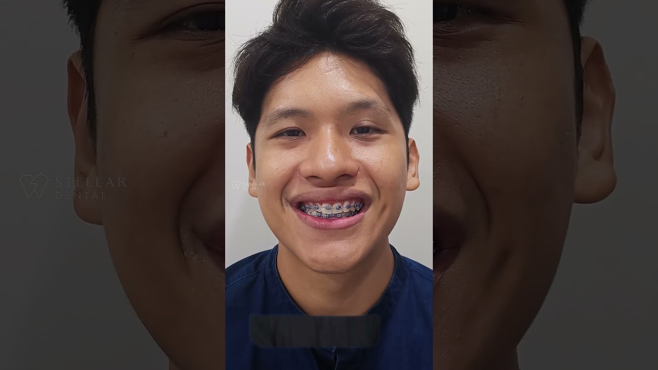 Braces Do More Than Align Teeth