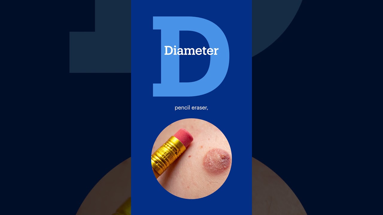 ABCDEs of melanoma and skin cancer | Tufts Medicine