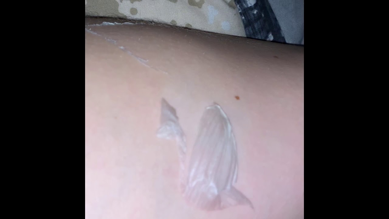 Satisfying Sunburn Peeling (Sound On)