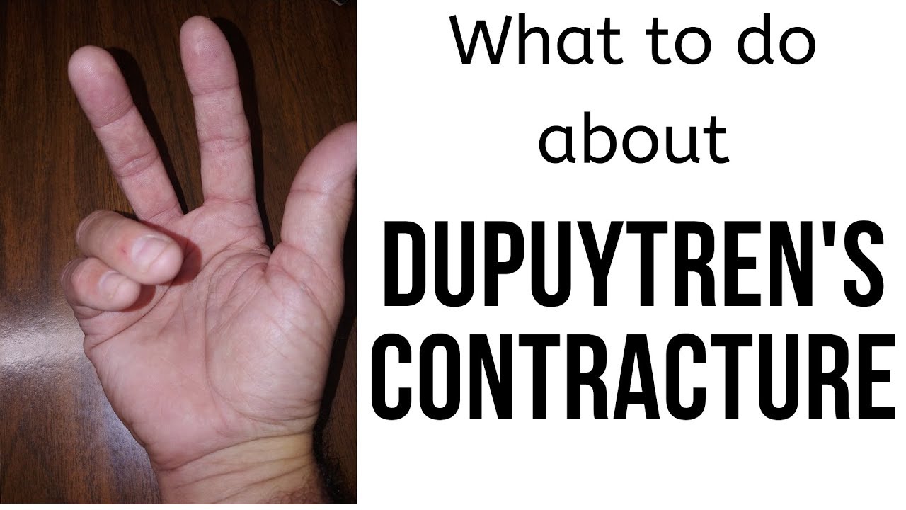 305 Rsw Dupuytren's Contracture