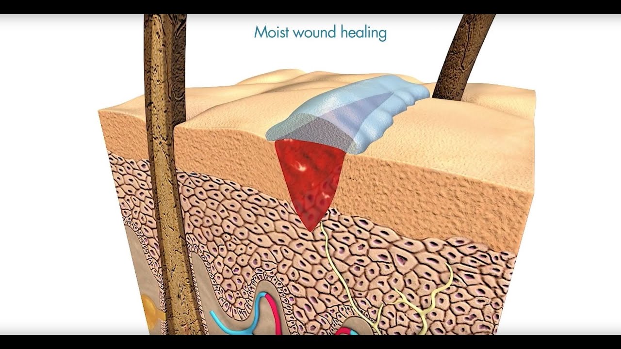 Flamigel | Optimal moist wound healing with Flamigel