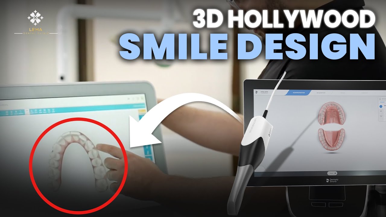 🤍 Что такое 3D-дизайн голливудской улыбки? — Стоматологическая клиника Lema