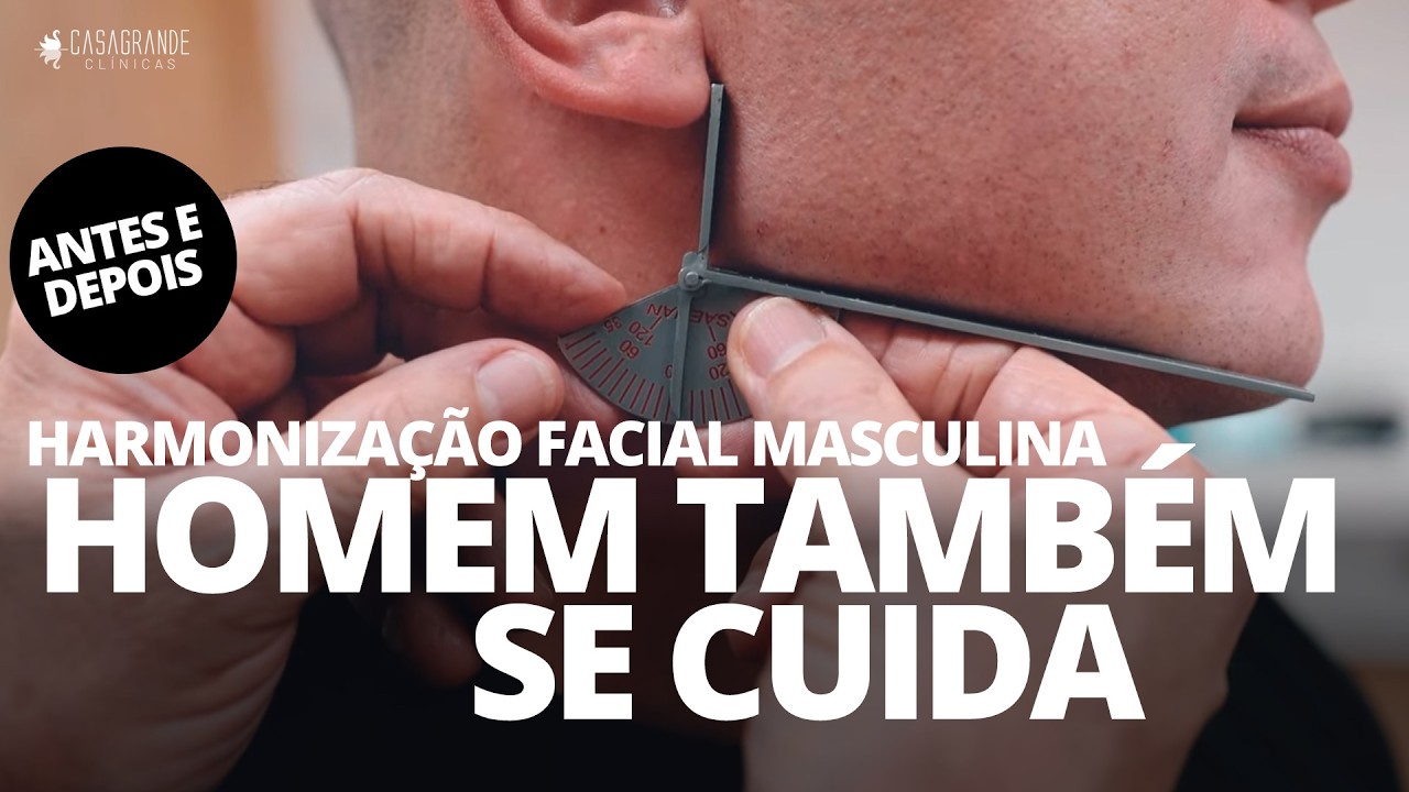 HARMONIZAÇÃO FACIAL MASCULINA  - Antes e depois com resultado NATURAL