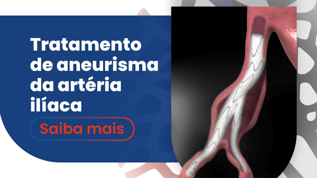 Tratamento de aneurisma da artéria ilíaca | Dr. Luis Gustavo Hernandes