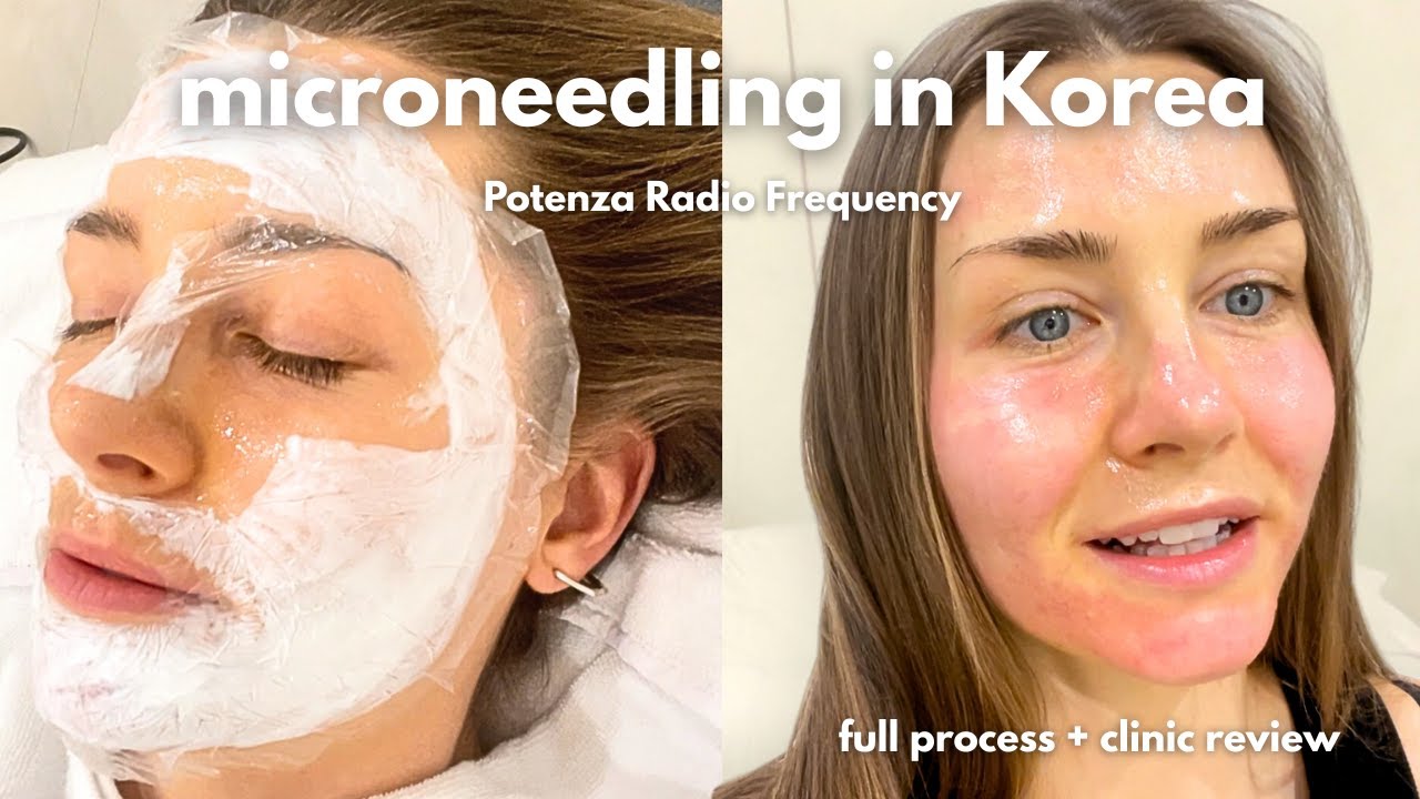 80$ Micro-needling skin treatment in Korea | Review + What to Know About Clinics