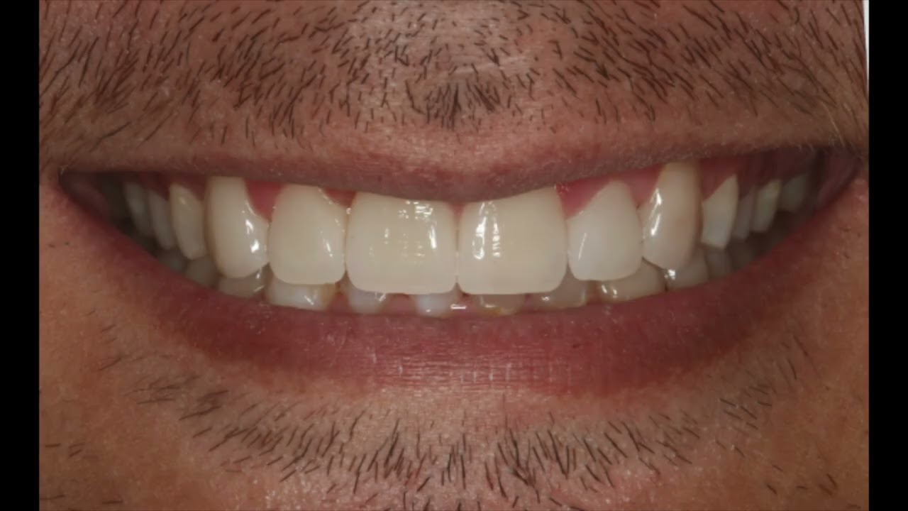 Closing Diastema of extreme decay and gum issues