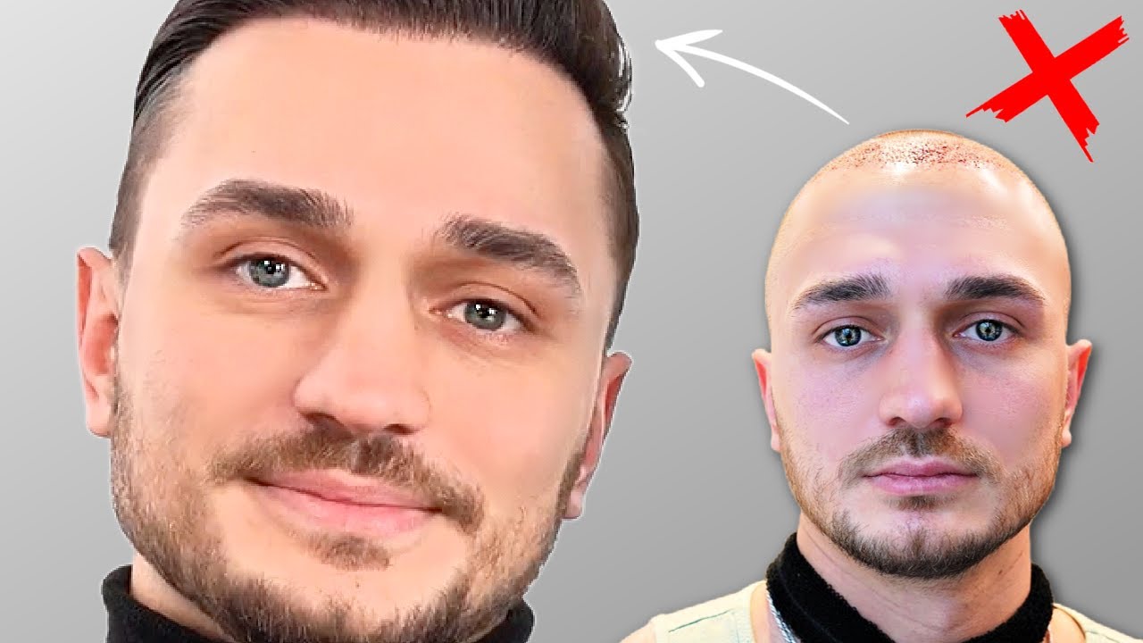 Rudis Ergebnis nach 10 Monaten | Haartransplantation Erfahrung
