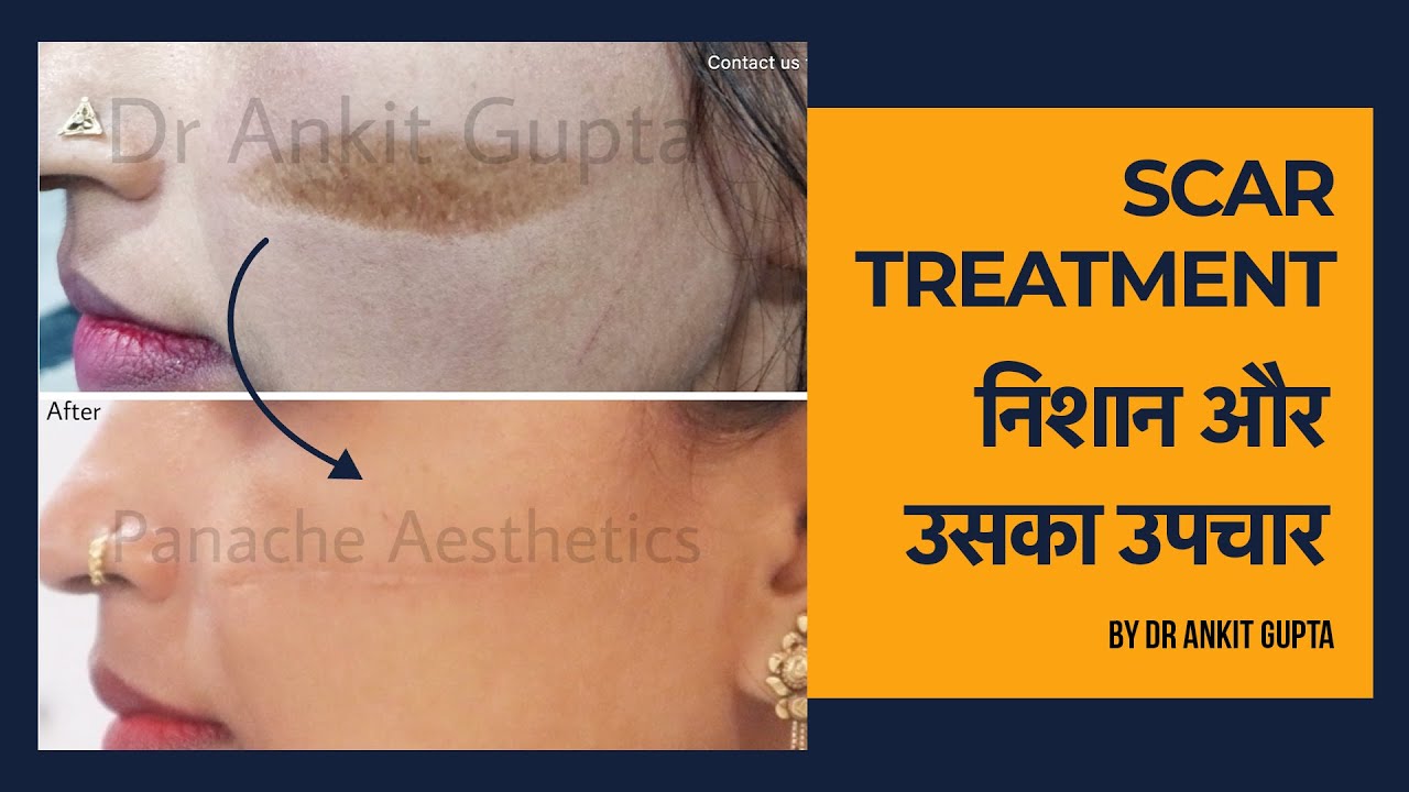 Scar Treatment and Scar Revision Surgery - Treatment for Light Scars and Deeper Scars #scarrevision