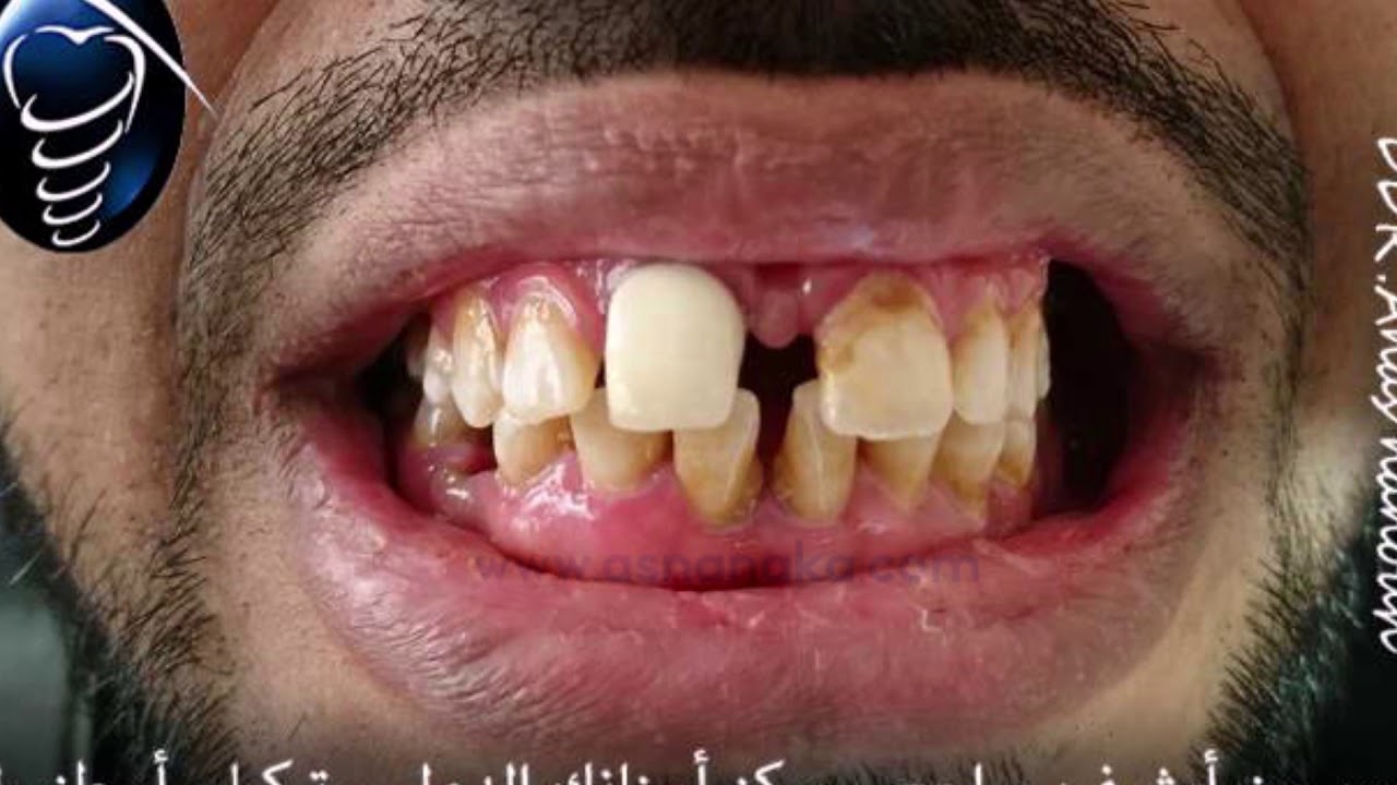 تقويم تباعد الأسنان او الفلجة بتركيبات زيركون اللافا خلال عشرة أيام