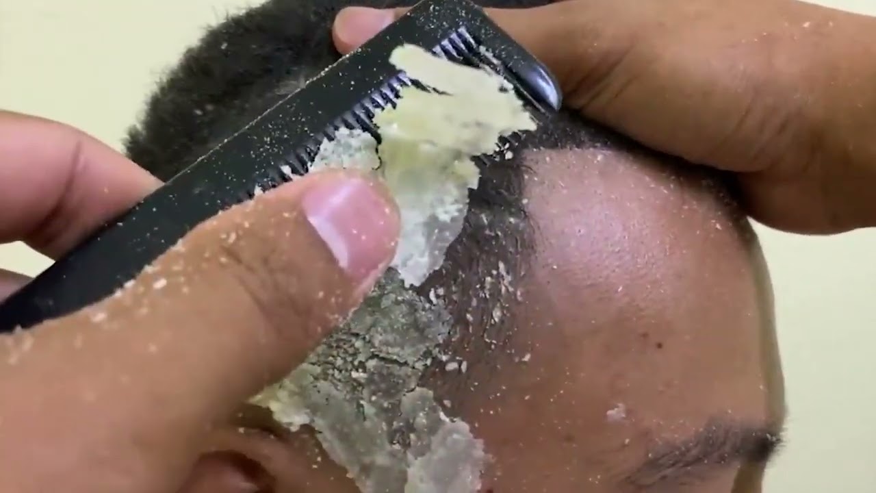 DRY SCALP !! Big Flakes Dandruff Scratching 🥱 #103