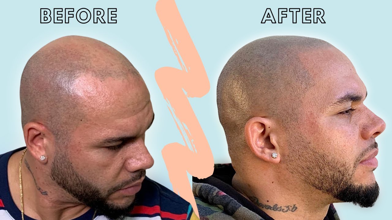 Scalp Micropigmentation Houston, TX