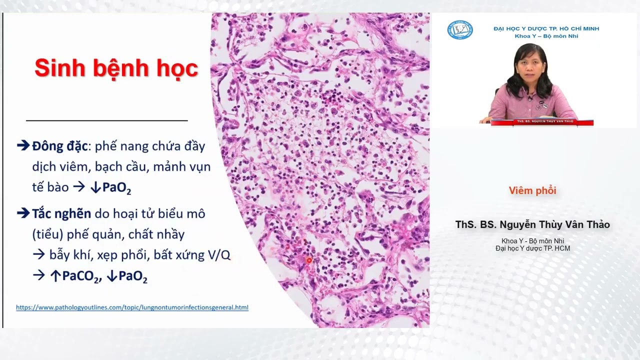 BÀI GIẢNG NHI KHOA: Viêm Phổi Nhi - Bài giảng YDS