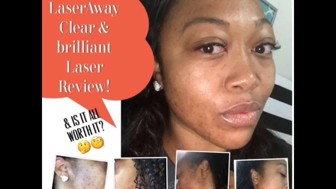 My Clear & Brilliant Laser Review After 2 Sessions for Acne Scars |LaserAway|